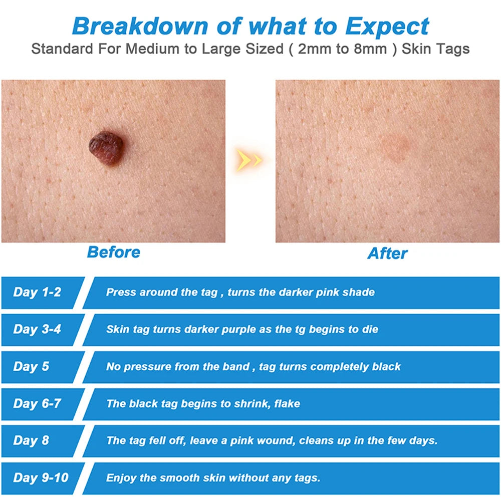 2-in-1 Automatic Skin Tag & Mole Remover