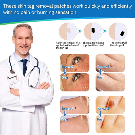 2-in-1 Automatic Skin Tag & Mole Remover